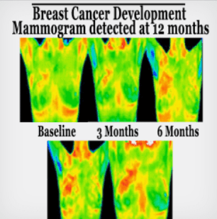 BRCATherm