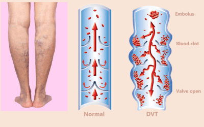 Thermography and Deep Vein Thrombosis – Why important now?